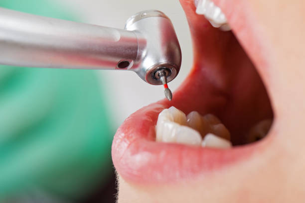Best Broken or Cracked Tooth Emergency Dentist in Millis Clicquot, MA